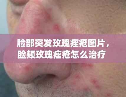 脸部突发玫瑰痤疮图片,脸颊玫瑰痤疮怎么治疗